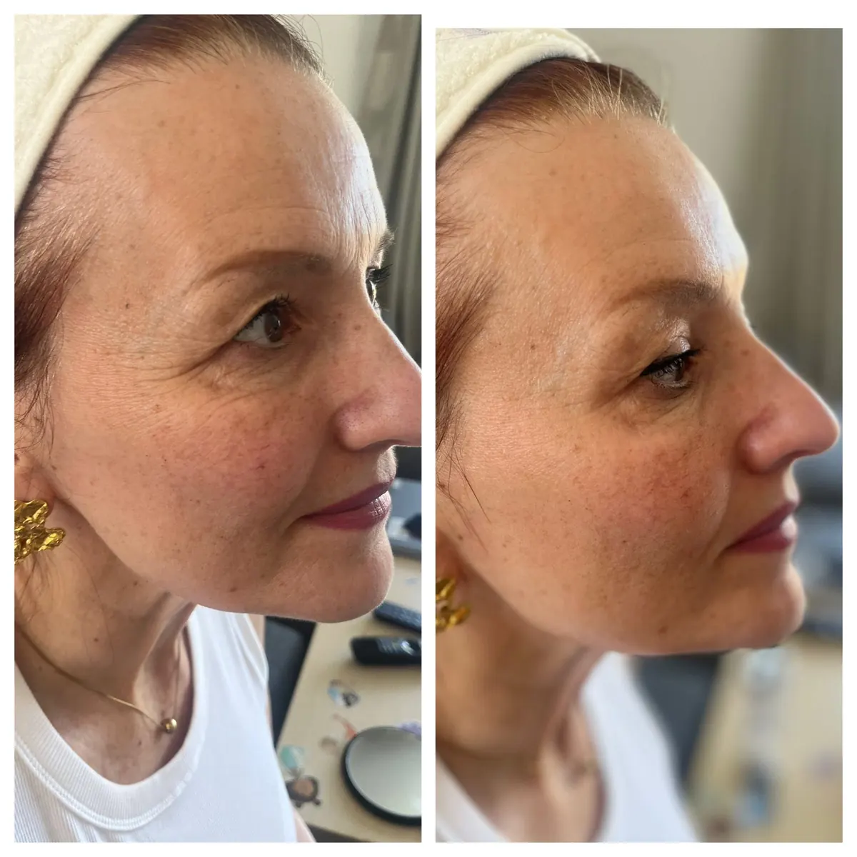 Teljes profil anti-aging és komplex lifting
